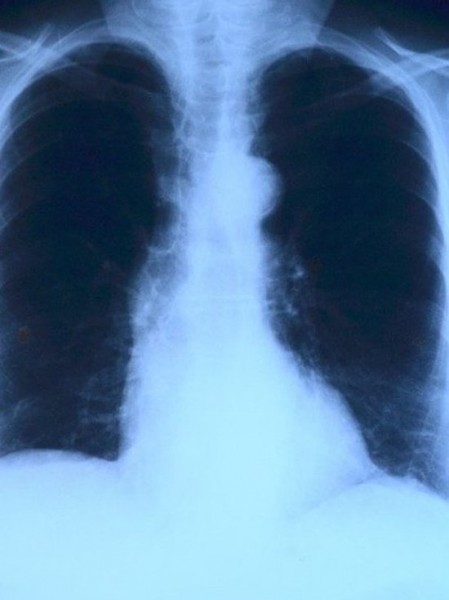 За год число внебольничных пневмоний в Татарстане выросло вдвое За год число внебольничных пневмоний в Татарстане выросло вдвое