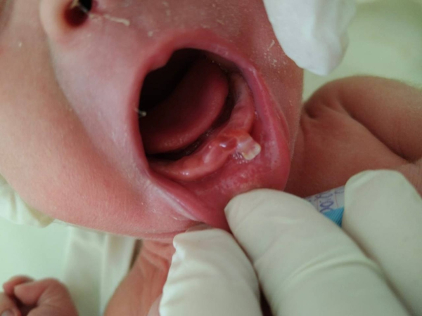 В Уфе родился малыш с редкой патологией В Уфе родился малыш с редкой патологией